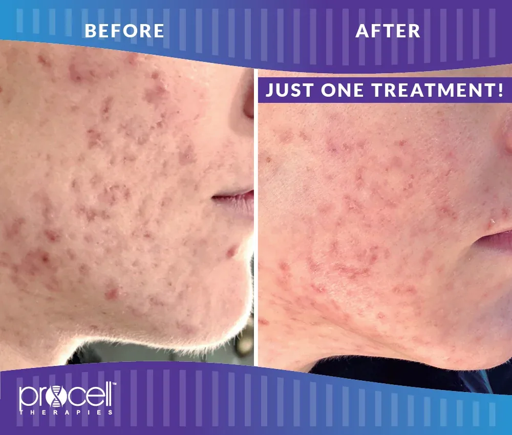 Before and after ProCell Microchanneling results for acne scarring after just one treatment