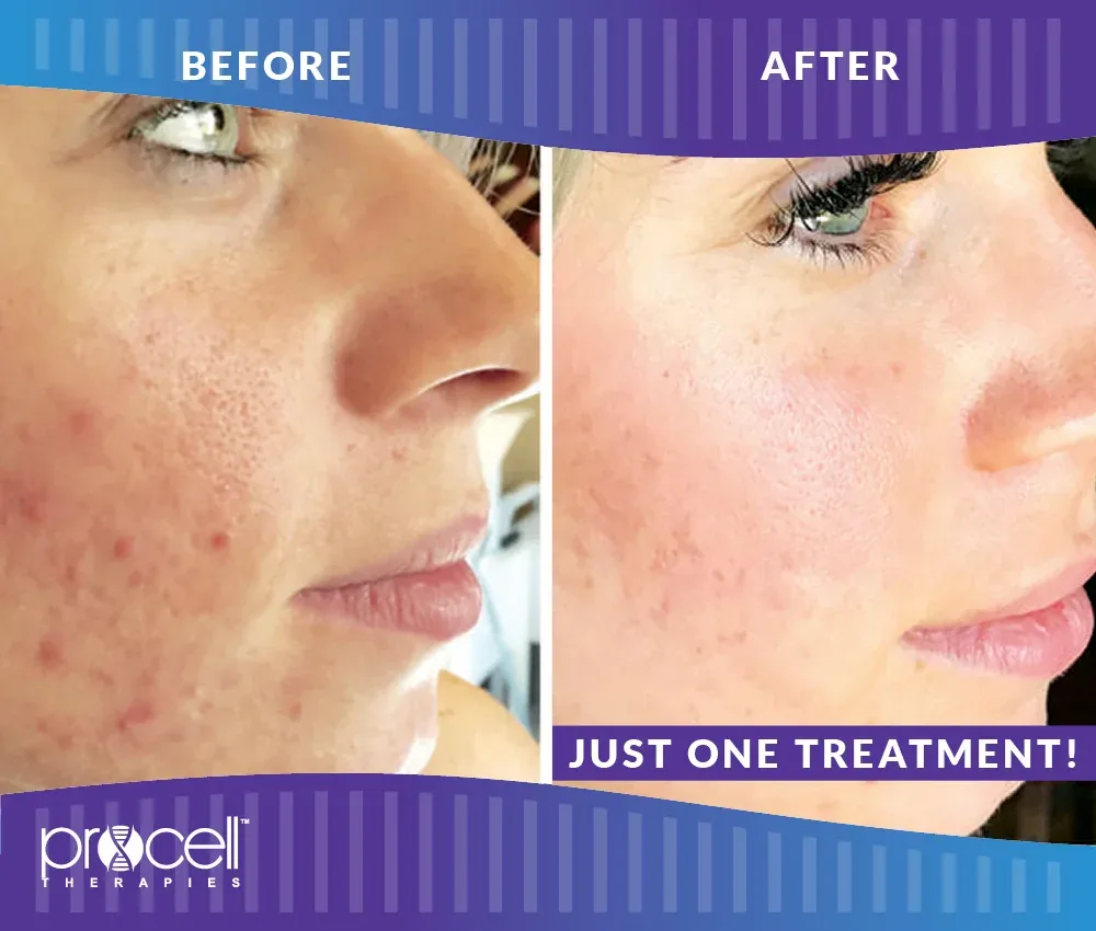 Before and after ProCell Microchanneling results for acne-prone skin after just one treatment
