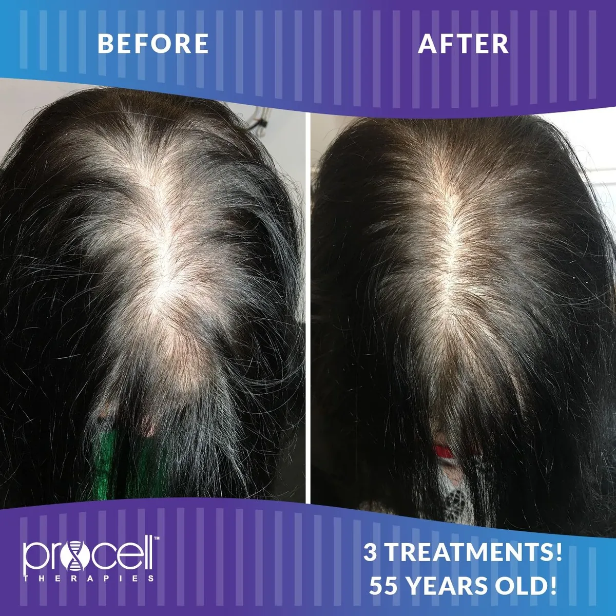 Before and after ProCell Microchanneling results for hair thinning after three treatments