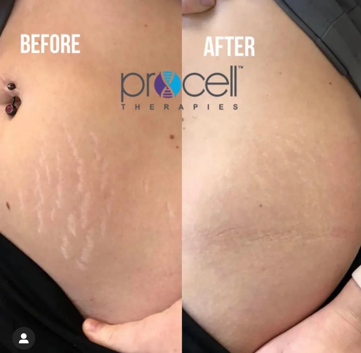 Before and after ProCell Microchanneling results for stretch marks