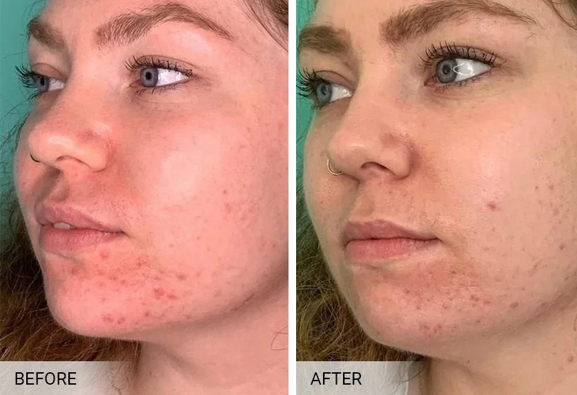 BioRePeel before and after — visibly reduced pigmentation and melasma