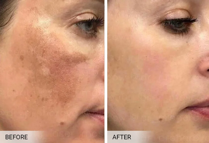 BioRePeel before and after — calmer, clearer acne-prone skin