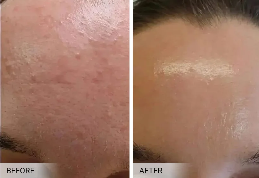BioRePeel before and after — brighter, more radiant full-face glow