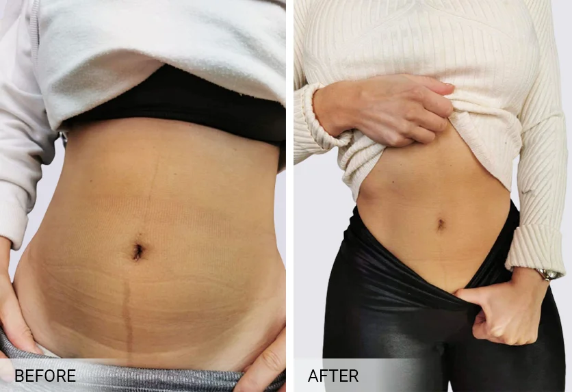 BioRePeel before and after — refined texture and smaller-looking pores