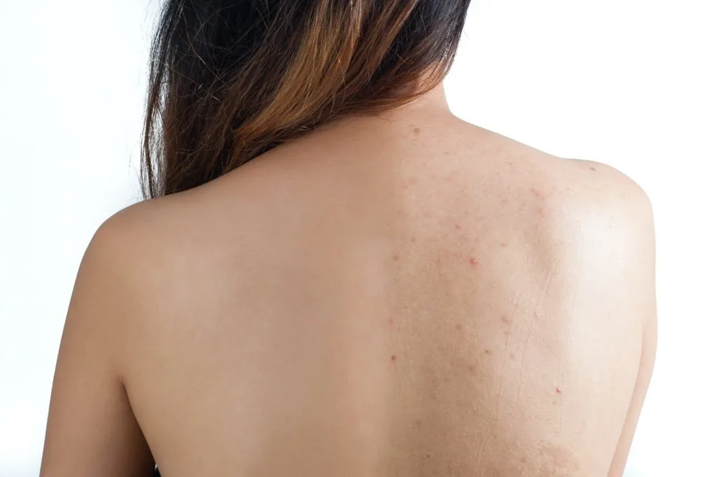 New York Back Facial and Staten Island Back Facial for Staten Island bacne (SI backne) at SI Glam Glow